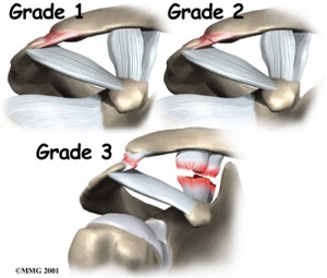 shoulder_acromioclavicular_separation_anat04